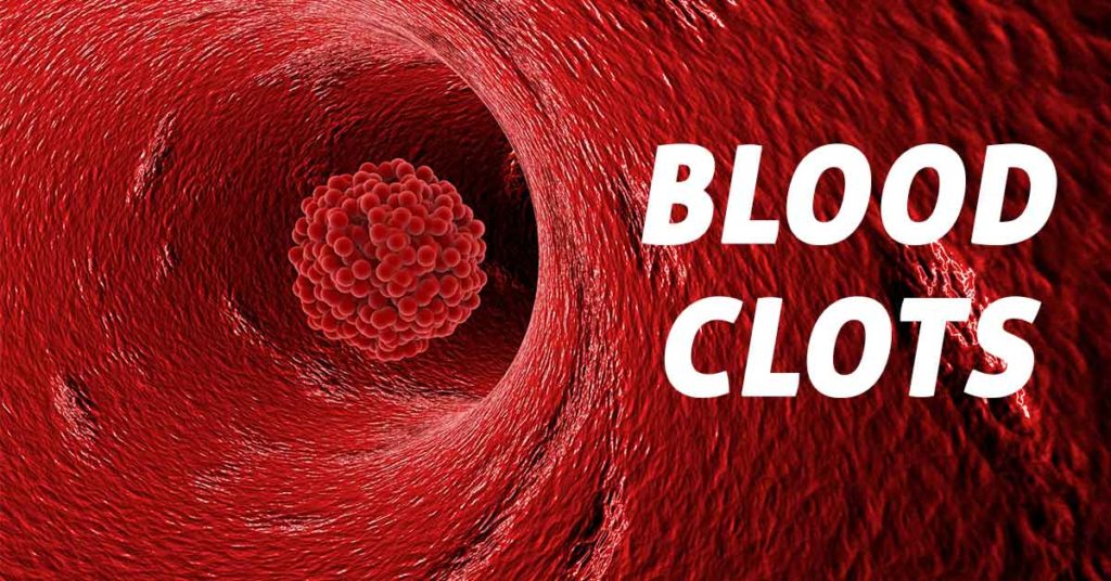 Blood Clot Symptoms