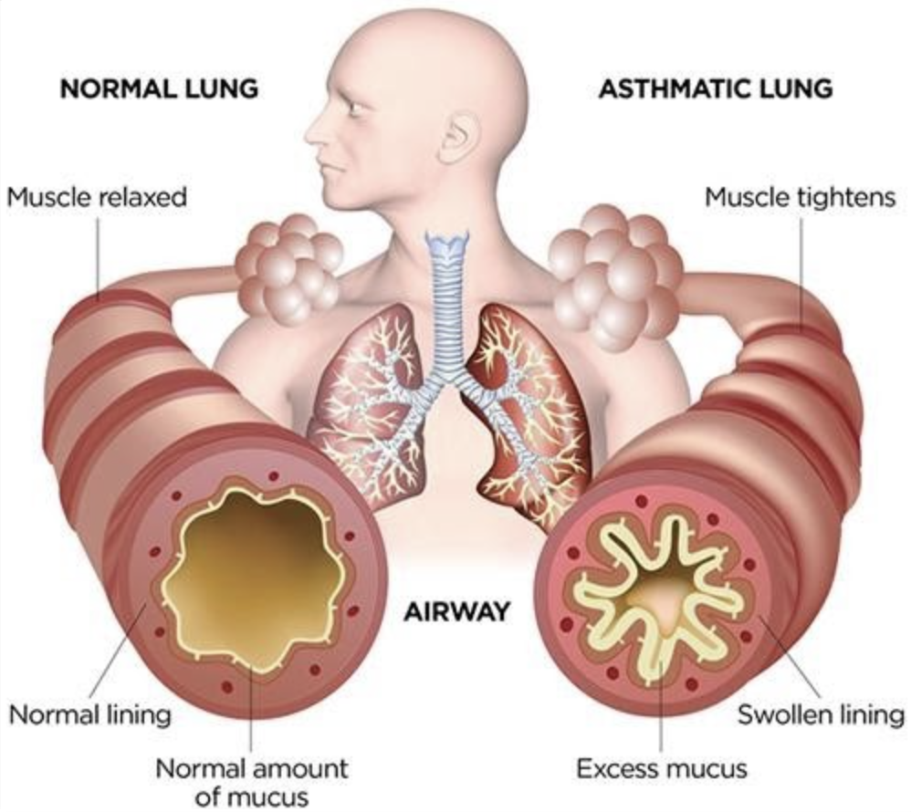 Normal Lung vs Asthmatic Lung