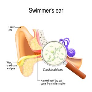 Swimmer's Ear