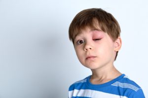 Eye Injuries – When to Go to the ER